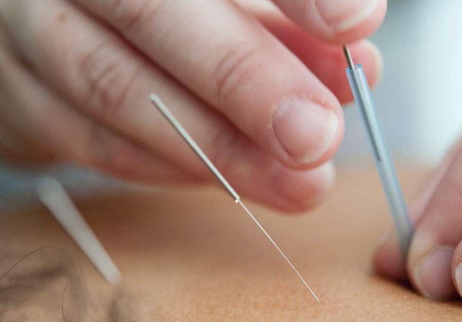 Acupuntura y Ventosas