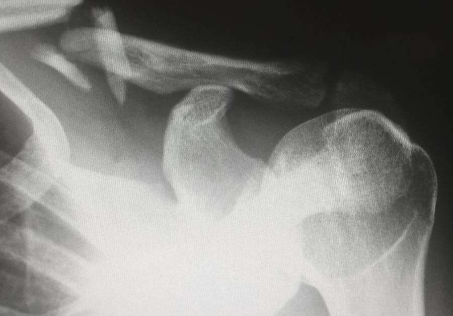 Fracturas por estrés comunes del pie